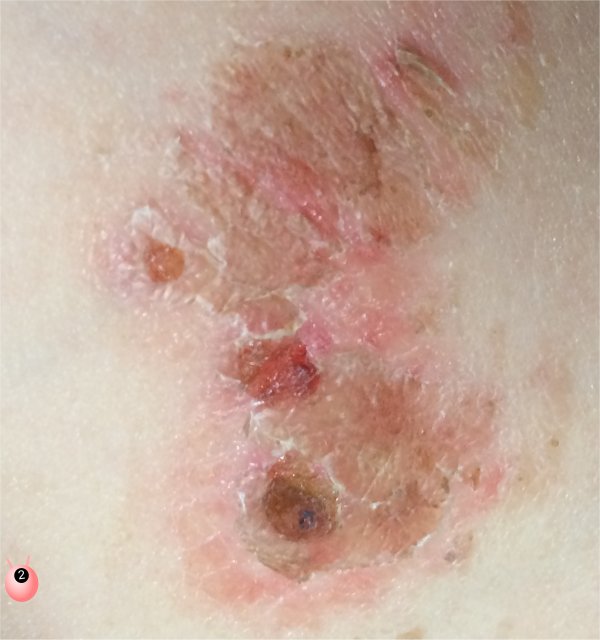 Molluscum Contagiosium | Pinkoddy's Blog